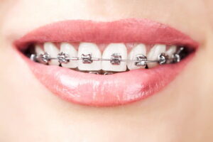 Wonderful silver braces