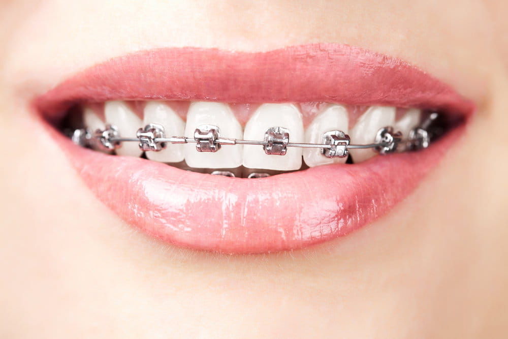 Hidden Braces  Lingual Braces (INBRACE) in Whittier, CA