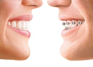 Compare and contrast invisalign vs. braces at Milnor Orthodontics.
