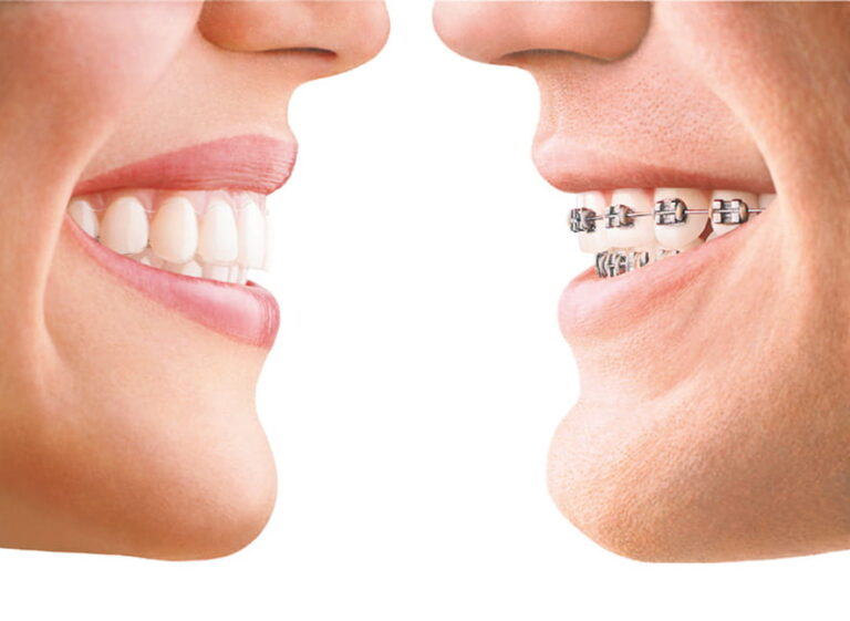 Invisalign vs. Braces Milnor Orthodontics Fort Collins, CO