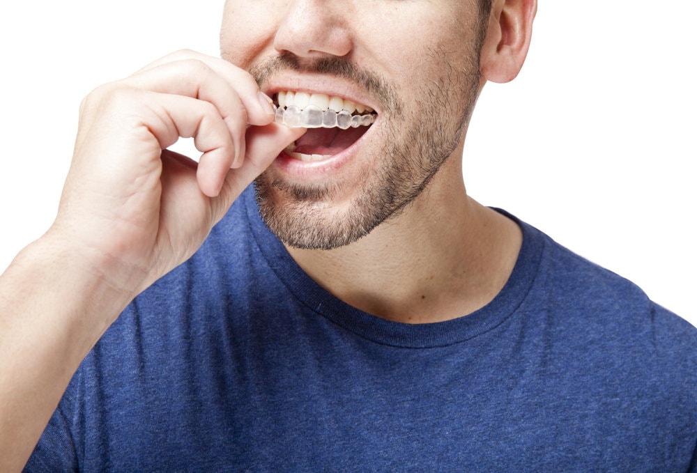 What is Invisalign®? Learn more about affordable Invisalign in Fort Collins at Milnor Orthodontics