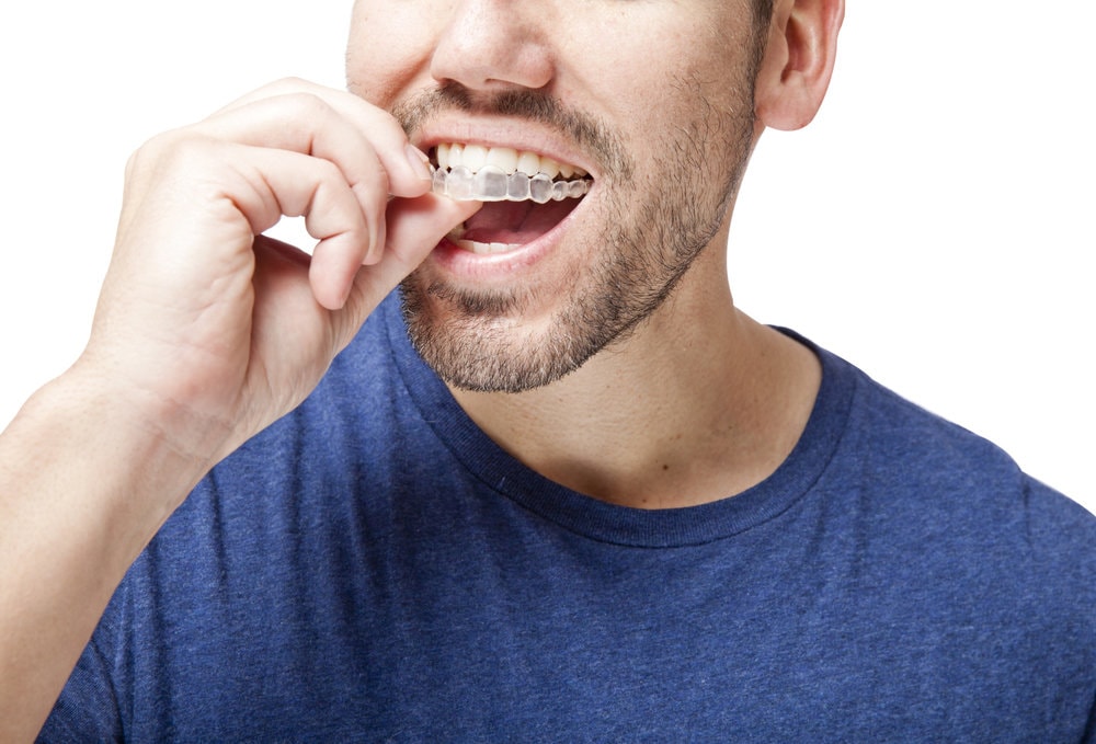 man putting in Invisalign clear aligners on his teeth