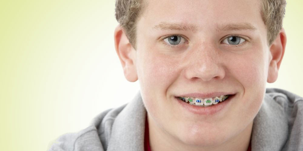 clear braces with purple bands