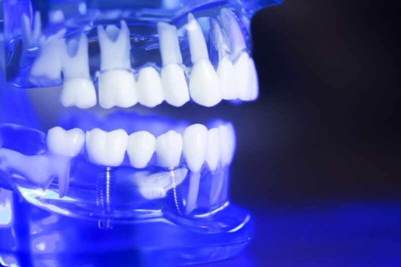 Braces with Veneers or Implants Milnor Orthodontics Fort Collins, CO