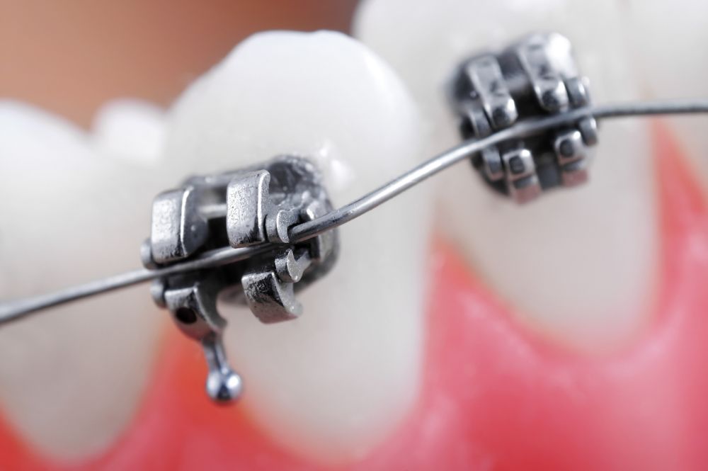Space Age Wire in Braces