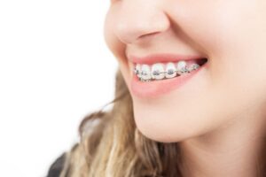 Learn what to expect when getting braces for the first time.