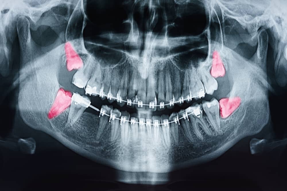 Is Wisdom Tooth Removal Orthodontic?  