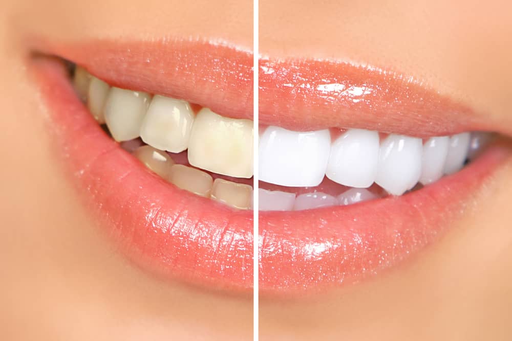 Learn about whitening your teeth from an orthodontist in Fort Collins CO