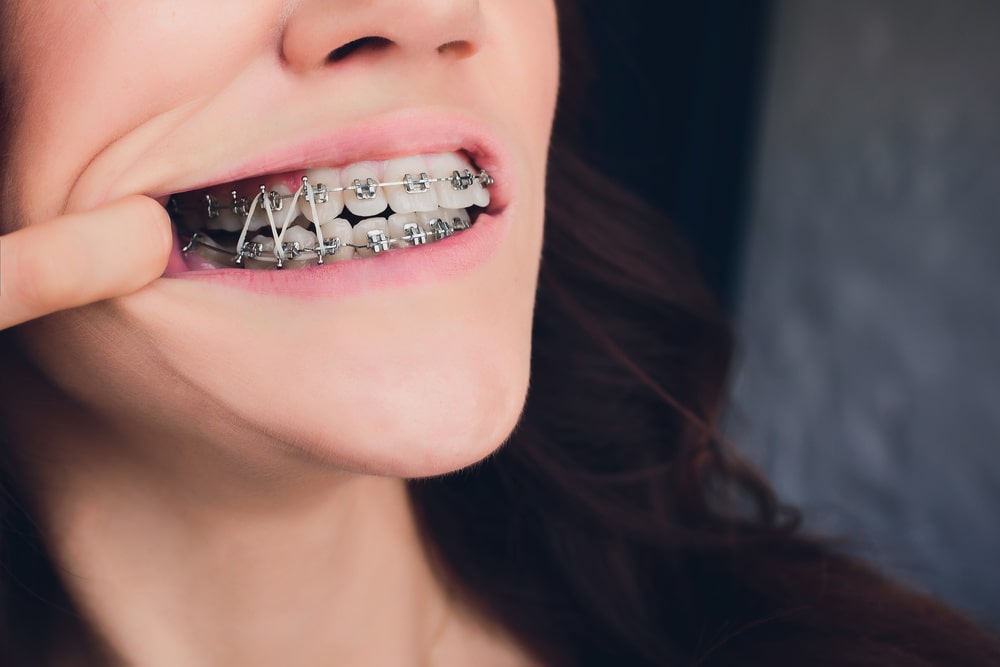 Braces Elastics (Rubber Bands) for Bite Correction and Alignment « Smile  Team Orthodontics