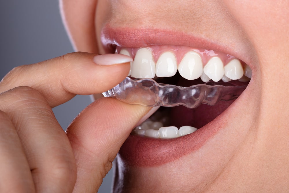 Here's what to do if you lose an Invisalign aligner in Ft Collins CO