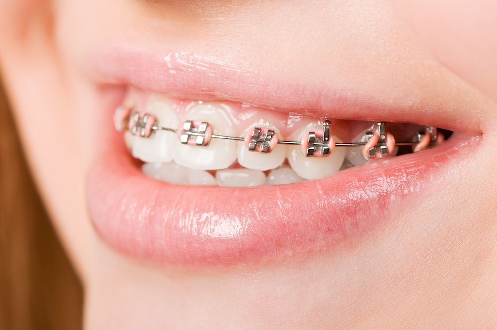 what the different parts of braces in Ft Collins CO do