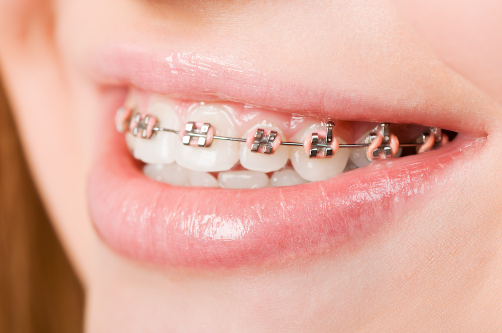 How The Different Parts Of Braces Fix Your Smile Orthodontist In Ft