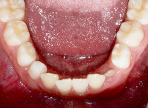 Lower Mouth 1