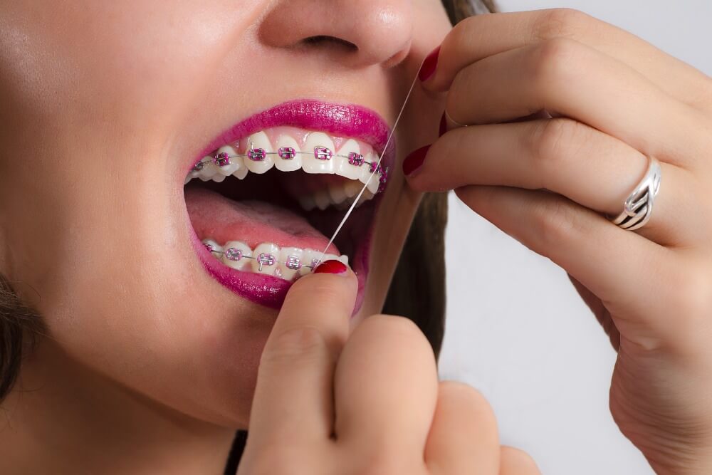 Nothing is more important than keeping your teeth healthy, especially when you're wearing braces. Be sure to floss!