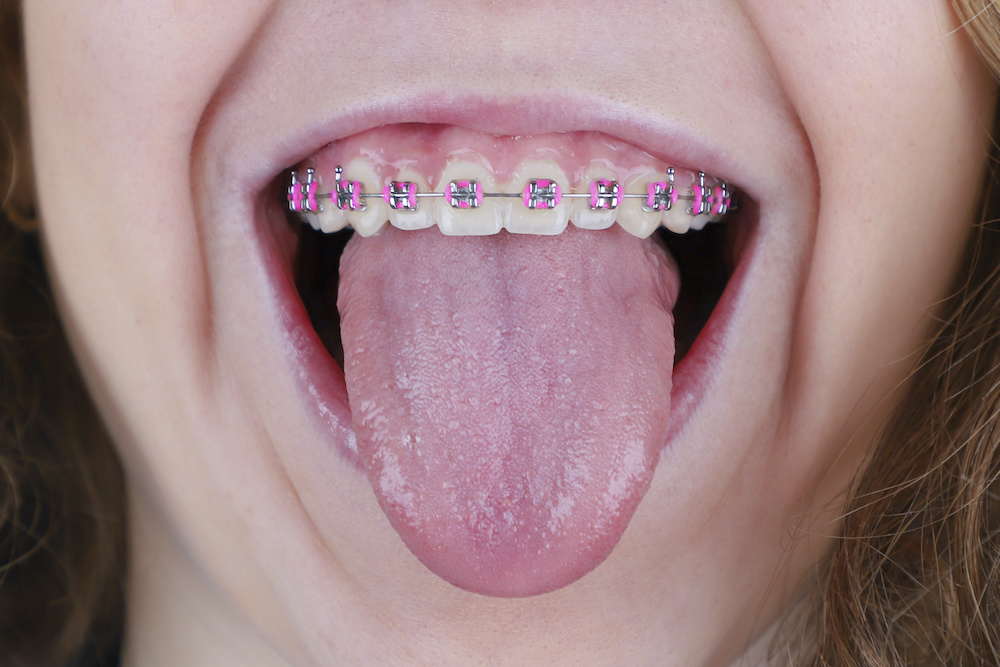 Learn what rubber bands on braces in Ft Collins CO do