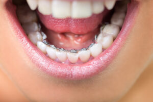 Are braces behind the teeth right for you? Find out from an orthodontist in Fort Collins CO
