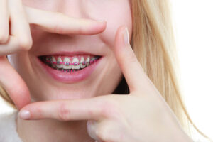 Here are ways you can straighten your teeth fast. Learn more from Milnor Orthodontics.