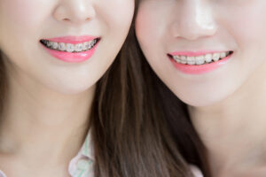 Here is why your braces look different than your friends.