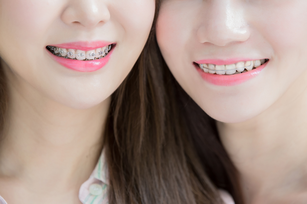 Here is why your braces look different than your friends.