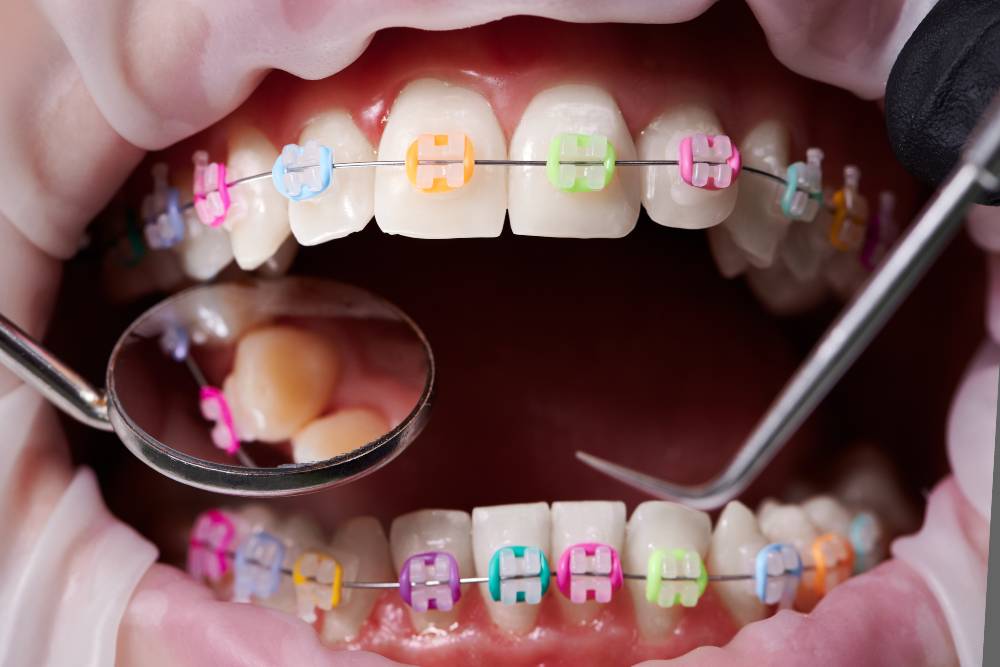 childrens braces