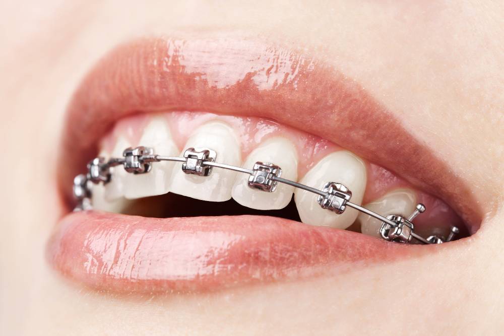braces cause or correct lisp