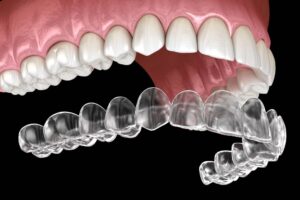 invisalign retention