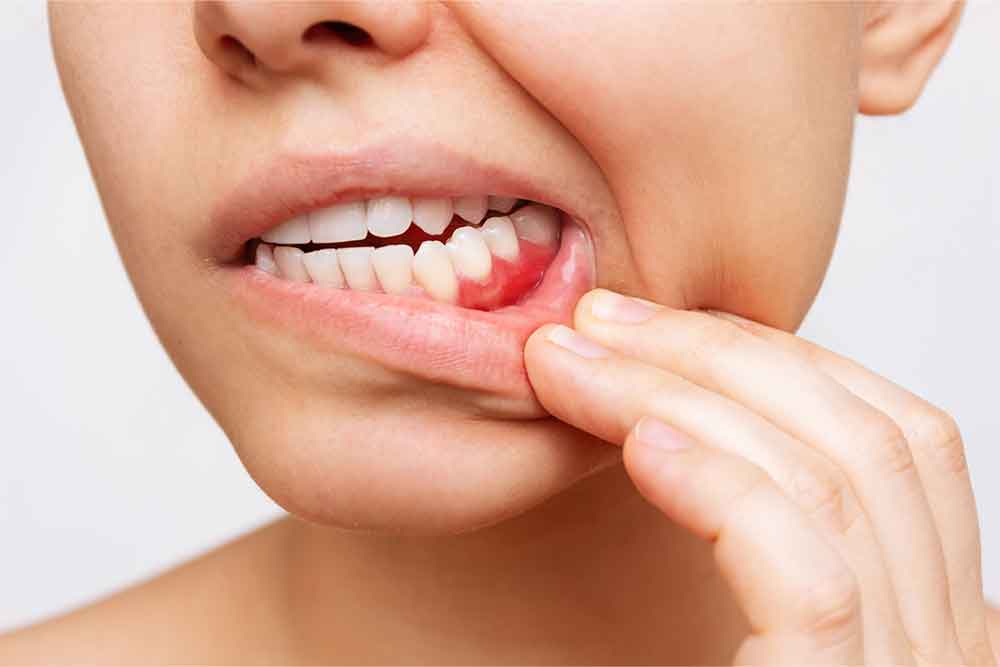do braces cause swollen gums