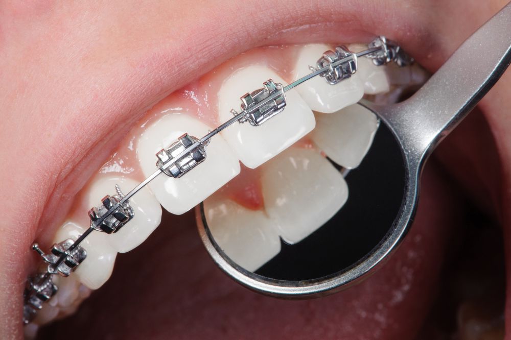 Orthodontic Braces