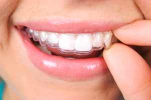 What to Know About Retainers Understanding Types, Usage, and Maintenance