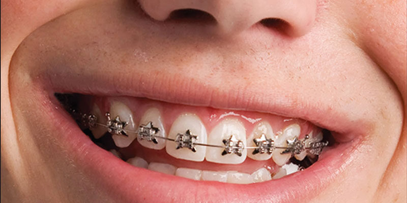 Your child will love WildSmiles Braces in Fort Collins CO from Milnor Orthodontics